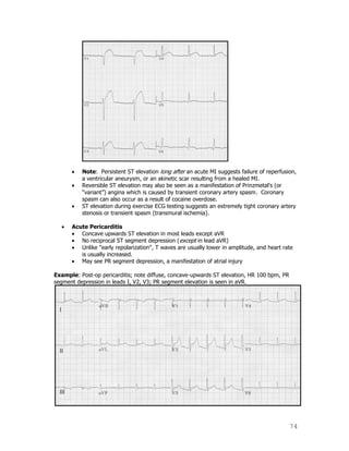 74
Note: Persistent ST elevation long after an acute MI suggests failure of reperfusion,
a ventricular aneurysm, or an akinetic scar resulting from a healed MI.
Reversible ST elevation may also be seen as a manifestation of Prinzmetal's (or
“variant”) angina which is caused by transient coronary artery spasm. Coronary
spasm can also occur as a result of cocaine overdose.
ST elevation during exercise ECG testing suggests an extremely tight coronary artery
stenosis or transient spasm (transmural ischemia).
Acute Pericarditis
Concave upwards ST elevation in most leads except aVR
No reciprocal ST segment depression (except in lead aVR)
Unlike "early repolarization", T waves are usually lower in amplitude, and heart rate
is usually increased.
May see PR segment depression, a manifestation of atrial injury
Example: Post-op pericarditis; note diffuse, concave-upwards ST elevation, HR 100 bpm, PR
segment depression in leads I, V2, V3; PR segment elevation is seen in aVR.
 