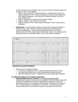 75
The ECG changes of acute pericarditis evolve over time through the following stages (not
all stages are seen in every patient):
Stage I: concave upwards ST segment elevation in most leads with reciprocal ST
segment depression in aVR. During this stage there is also atrial injury represented
by PR segment depression in many leads and PR segment elevation in aVR (see
above example, p74).
Stage II: resolution of ST segment and PR segment changes
Stage III: diffuse T wave inversion in many leads
Stage IV: resolution of the T wave changes or persistent T wave inversion (chronic
pericarditis)
Hypothermia: In this interesting condition the onset of the ST segment (called the J-
point) turns into a wider J-wave as a result of increased transmural dispersion of
ventricular repolarization. The ECG below illustrates these prominent “J-Waves”
following most of the QRS complexes (also called „Osborn‟ waves). This homeless person
was found comatose in December outside in a park. Note also atrial fibrillation.
Hypothermia and Atrial Fibrillation
Other Causes or ST segment elevation:
Left ventricular hypertrophy (seen in right precordial leads with large S-waves)
Left bundle branch block (seen in right precordial leads with large S-waves)
Advanced hyperkalemia (seen in multiple ECG leads with widened QRS complexes)
II. Differential Diagnosis of ST Segment Depression
Subendocardial ischemia: Example: During Exercise ECG stress testing
Subendocardial ischemia is the most common expression of ischemia during exercise ECG
testing and is manifested as horizontal or downsloping ST depression mainly in the
lateral precordial leads. The progression of these changes is illustrated in the figures on
p76. Transmural ischemia is manifested by ST elevation. The leads showing the ST
elevation often point to a critical lesion (or spasm) in a particular coronary artery.
 