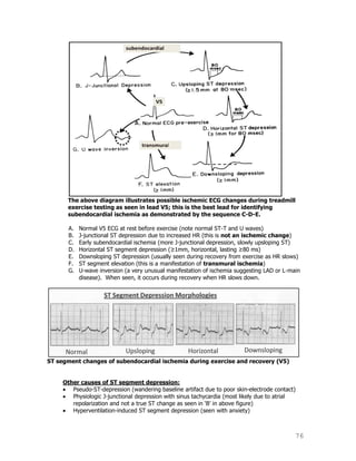 76
The above diagram illustrates possible ischemic ECG changes during treadmill
exercise testing as seen in lead V5; this is the best lead for identifying
subendocardial ischemia as demonstrated by the sequence C-D-E.
A. Normal V5 ECG at rest before exercise (note normal ST-T and U waves)
B. J-junctional ST depression due to increased HR (this is not an ischemic change)
C. Early subendocardial ischemia (more J-junctional depression, slowly upsloping ST)
D. Horizontal ST segment depression (≥1mm, horizontal, lasting ≥80 ms)
E. Downsloping ST depression (usually seen during recovery from exercise as HR slows)
F. ST segment elevation (this is a manifestation of transmural ischemia)
G. U-wave inversion (a very unusual manifestation of ischemia suggesting LAD or L-main
disease). When seen, it occurs during recovery when HR slows down.
ST segment changes of subendocardial ischemia during exercise and recovery (V5)
Other causes of ST segment depression:
Pseudo-ST-depression (wandering baseline artifact due to poor skin-electrode contact)
Physiologic J-junctional depression with sinus tachycardia (most likely due to atrial
repolarization and not a true ST change as seen in „B‟ in above figure)
Hyperventilation-induced ST segment depression (seen with anxiety)
 