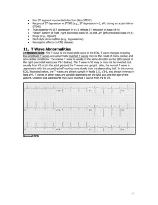 77
Non ST segment myocardial infarction (Non-STEMI)
Reciprocal ST depression in STEMI (e.g., ST depression in I, aVL during an acute inferior
STEMI)
True posterior MI (ST depression in V1-3 reflects ST elevation in leads V8-9)
“Strain” pattern of RVH (right precordial leads V1-3) and LVH (left precordial leads V5-6)
Drugs (e.g., digoxin)
Electrolyte abnormalities (e.g., hypokalemia)
Neurogenic effects (in CNS disease)
11. T Wave Abnormalities
INTRODUCTION: The T wave is the most labile wave in the ECG. T wave changes including
low-amplitude T waves and abnormally inverted T waves may be the result of many cardiac and
non-cardiac conditions. The normal T wave is usually in the same direction as the QRS except in
the right precordial leads (see V1-3 below). The T wave in V1 may or may not be inverted, but
usually from V2 on (in the adult person) the T waves are upright. Also, the normal T wave is
asymmetric with the ascending half moving more slowly than the descending half. In the normal
ECG, illustrated below, the T waves are always upright in leads I, II, V3-6, and always inverted in
lead aVR. T waves in other leads are variable depending on the QRS axis and the age of the
patient. Children and adolescents may have inverted T waves from V1 to V3.
Normal ECG
 
