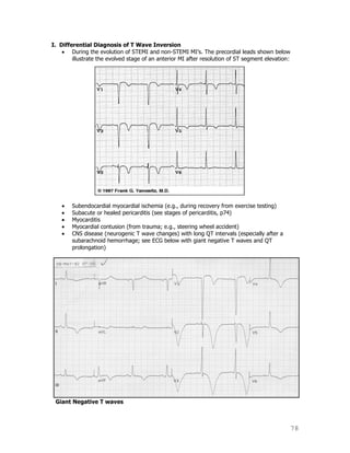 78
I. Differential Diagnosis of T Wave Inversion
During the evolution of STEMI and non-STEMI MI‟s. The precordial leads shown below
illustrate the evolved stage of an anterior MI after resolution of ST segment elevation:
Subendocardial myocardial ischemia (e.g., during recovery from exercise testing)
Subacute or healed pericarditis (see stages of pericarditis, p74)
Myocarditis
Myocardial contusion (from trauma; e.g., steering wheel accident)
CNS disease (neurogenic T wave changes) with long QT intervals (especially after a
subarachnoid hemorrhage; see ECG below with giant negative T waves and QT
prolongation)
Giant Negative T waves
 
