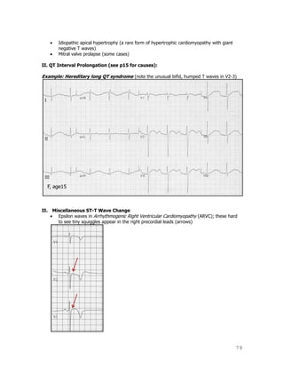 79
Idiopathic apical hypertrophy (a rare form of hypertrophic cardiomyopathy with giant
negative T waves)
Mitral valve prolapse (some cases)
II. QT Interval Prolongation (see p15 for causes):
Example: Hereditary long QT syndrome (note the unusual bifid, humped T waves in V2-3)
II. Miscellaneous ST-T Wave Change
Epsilon waves in Arrhythmogenic Right Ventricular Cardiomyopathy (ARVC); these hard
to see tiny squiggles appear in the right precordial leads (arrows)
 