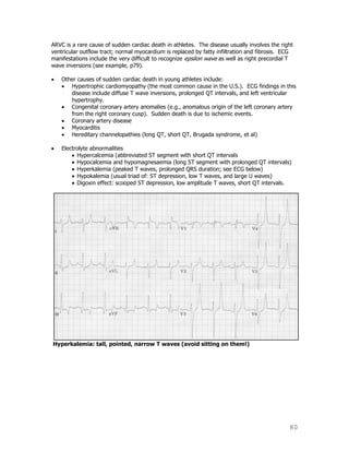 80
ARVC is a rare cause of sudden cardiac death in athletes. The disease usually involves the right
ventricular outflow tract; normal myocardium is replaced by fatty infiltration and fibrosis. ECG
manifestations include the very difficult to recognize epsilon wave as well as right precordial T
wave inversions (see example, p79).
Other causes of sudden cardiac death in young athletes include:
Hypertrophic cardiomyopathy (the most common cause in the U.S.). ECG findings in this
disease include diffuse T wave inversions, prolonged QT intervals, and left ventricular
hypertrophy.
Congenital coronary artery anomalies (e.g., anomalous origin of the left coronary artery
from the right coronary cusp). Sudden death is due to ischemic events.
Coronary artery disease
Myocarditis
Hereditary channelopathies (long QT, short QT, Brugada syndrome, et al)
Electrolyte abnormalities
Hypercalcemia (abbreviated ST segment with short QT intervals
Hypocalcemia and hypomagnesaemia (long ST segment with prolonged QT intervals)
Hyperkalemia (peaked T waves, prolonged QRS duration; see ECG below)
Hypokalemia (usual triad of: ST depression, low T waves, and large U waves)
Digoxin effect: scooped ST depression, low amplitude T waves, short QT intervals.
Hyperkalemia: tall, pointed, narrow T waves (avoid sitting on them!)
 