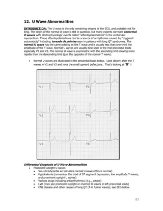 82
12. U Wave Abnormalities
INTRODUCTION: The U wave is the only remaining enigma of the ECG, and probably not for
long. The origin of the normal U wave is still in question, but many experts correlate abnormal
U waves with electrophysiologic events called "afterdepolarizations" in the ventricular
myocardium. These afterdepolarizations can be a source of arrhythmias caused by "triggered
automaticity" including torsade de pointes seen in patients with long QT syndromes. The
normal U wave has the same polarity as the T wave and is usually less than one-third the
amplitude of the T wave. Normal U waves are usually best seen in the mid-precordial leads
especially V2 and V3. The normal U wave is asymmetric with the ascending limb moving more
rapidly than the descending limb (just the opposite of the normal T wave).
Normal U waves are illustrated in the precordial leads below. Look closely after the T
waves in V2 and V3 and note the small upward deflections. That‟s looking at „U‟ !!
Differential Diagnosis of U Wave Abnormalities
Prominent upright U waves
Sinus bradycardia accentuates normal U waves (this is normal)
Hypokalemia (remember the triad of ST segment depression, low amplitude T waves,
and prominent upright U waves)
Various drugs including antiarrhythmics (e.g., sotolol)
LVH (may see prominent upright or inverted U waves in left precordial leads)
CNS disease and other causes of long QT (T-U fusion waves); see ECG below.
 