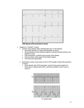 83
CNS disease with prominent U waves
Negative or "inverted" U waves
Ischemic heart disease (often indicating left main or LAD disease)
Myocardial infarction (in leads with pathologic Q waves)
During episode of acute ischemia (angina or exercise-induced ischemia; see
diagram on p75)
Post extrasystolic in patients with coronary heart disease
During coronary artery spasm (Prinzmetal's angina)
Left ventricular hypertrophy
Nonischemic causes: some cases of LVH or RVH (usually in leads with prominent
R waves)
Some patients with LQTS (see below: Lead V6 shows giant negative TU
fusion wave in patient with LQTS; a prominent upright U wave is seen in
Lead V1)
 