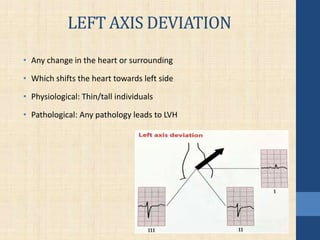 LEFT AXIS DEVIATION
• Any change in the heart or surrounding
• Which shifts the heart towards left side
• Physiological: Thin/tall individuals
• Pathological: Any pathology leads to LVH
 
