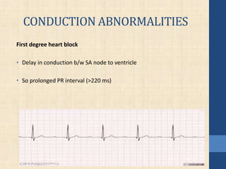 CONDUCTION ABNORMALITIES
First degree heart block
• Delay in conduction b/w SA node to ventricle
• So prolonged PR interval (>220 ms)
 