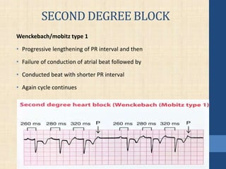 SECOND DEGREE BLOCK
Wenckebach/mobitz type 1
• Progressive lengthening of PR interval and then
• Failure of conduction of atrial beat followed by
• Conducted beat with shorter PR interval
• Again cycle continues
 