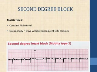 SECOND DEGREE BLOCK
Mobitz type 2
• Constant PR interval
• Occasionally P wave without subsequent QRS complex
 