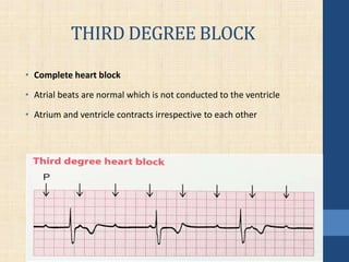 THIRD DEGREE BLOCK
• Complete heart block
• Atrial beats are normal which is not conducted to the ventricle
• Atrium and ventricle contracts irrespective to each other
 