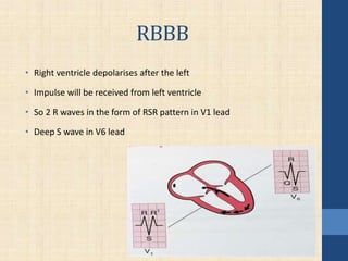 RBBB
• Right ventricle depolarises after the left
• Impulse will be received from left ventricle
• So 2 R waves in the form of RSR pattern in V1 lead
• Deep S wave in V6 lead
 