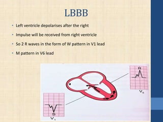 LBBB
• Left ventricle depolarises after the right
• Impulse will be received from right ventricle
• So 2 R waves in the form of W pattern in V1 lead
• M pattern in V6 lead
 