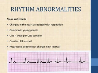 RHYTHM ABNORMALITIES
Sinus arrhythmia
• Changes in the heart associated with respiration
• Common in young people
• One P wave per QRS complex
• Constant PR interval
• Progressive beat to beat change in RR interval
 