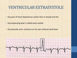 VENTRICULAR EXTRASYSTOLE
• Any part of heart depolarises earlier than it should and the
• Accompanying beat is called extra systole
• Occasionally vent. contracts on its own without atrial beat
 