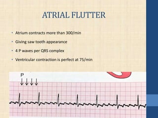 ATRIAL FLUTTER
• Atrium contracts more than 300/min
• Giving saw tooth appearance
• 4 P waves per QRS complex
• Ventricular contraction is perfect at 75/min
 