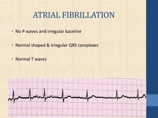 ATRIAL FIBRILLATION
• No P waves and irregular baseline
• Normal shaped & Irregular QRS complexes
• Normal T waves
 