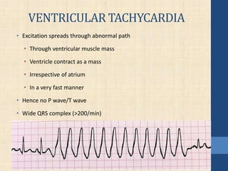VENTRICULAR TACHYCARDIA
• Excitation spreads through abnormal path
• Through ventricular muscle mass
• Ventricle contract as a mass
• Irrespective of atrium
• In a very fast manner
• Hence no P wave/T wave
• Wide QRS complex (>200/min)
 