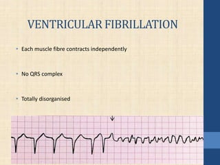 VENTRICULAR FIBRILLATION
• Each muscle fibre contracts independently
• No QRS complex
• Totally disorganised
 