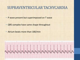 SUPRAVENTRICULAR TACHYCARDIA
• P wave present but superimposed on T wave
• QRS complex have same shape throughout
• Atrium beats more than 180/min
 