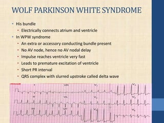 WOLF PARKINSON WHITE SYNDROME
• His bundle
• Electrically connects atrium and ventricle
• In WPW syndrome
• An extra or accessory conducting bundle present
• No AV node, hence no AV nodal delay
• Impulse reaches ventricle very fast
• Leads to premature excitation of ventricle
• Short PR interval
• QRS complex with slurred upstroke called delta wave
 