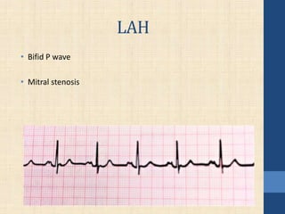 LAH
• Bifid P wave
• Mitral stenosis
 