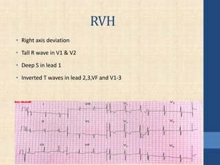 RVH
• Right axis deviation
• Tall R wave in V1 & V2
• Deep S in lead 1
• Inverted T waves in lead 2,3,VF and V1-3
 
