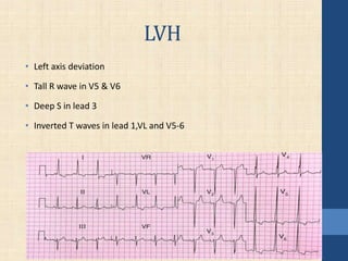 LVH
• Left axis deviation
• Tall R wave in V5 & V6
• Deep S in lead 3
• Inverted T waves in lead 1,VL and V5-6
 