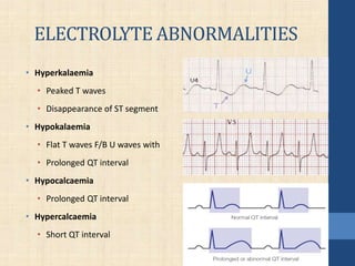 ELECTROLYTE ABNORMALITIES
• Hyperkalaemia
• Peaked T waves
• Disappearance of ST segment
• Hypokalaemia
• Flat T waves F/B U waves with
• Prolonged QT interval
• Hypocalcaemia
• Prolonged QT interval
• Hypercalcaemia
• Short QT interval
 