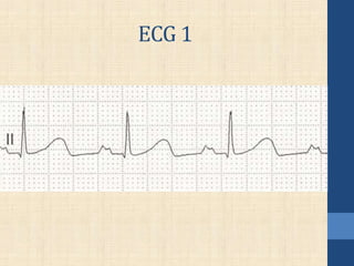 ECG 1
 