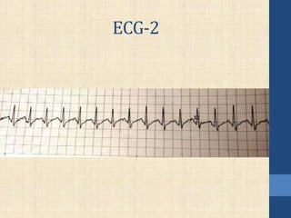 ECG-2
 