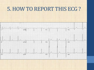 5. HOW TO REPORT THIS ECG ?
 