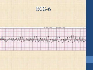 ECG-6
 