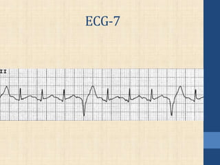 ECG-7
 