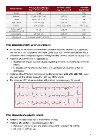 Preload Effected Rv Infarct Ecg | PDF