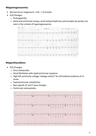 Ecg | PDF