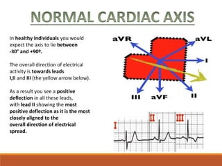 In healthy individuals you would 
expect the axis to lie between
-30° and +90º.
The overall direction of electrical 
activity is towards leads
I,II and III (the yellow arrow below).
As a result you see a positive
deflection in all these leads, 
with lead II showing the most
positive deflection as it is the most
closely aligned to the
overall direction of electrical
spread.
 