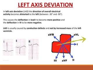 In left axis deviation (LAD) the direction of overall electrical
activity becomes distorted to the left (between -30° and -90°).
This causes the deflection in lead I to become more positive and 
the deflection in III to be more negative.
LAD is usually caused by conduction defects and not by increased mass of the left
ventricle.
LEFT AXIS DEVIATION
 