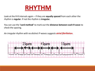 Look at the R-R intervals again – if they are equally spaced from each other the 
rhythm is regular. If not the rhythm is irregular.
You can use the ‘card method’ to mark out the distance between each R wave to 
check the spacing.
An irregular rhythm with no distinct P-waves suggests atrial fibrillation.
RHYTHM
 