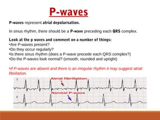 P-waves represent atrial depolarisation.
In sinus rhythm, there should be a P-wave preceding each QRS complex.
Look at the p waves and comment on a number of things:
•Are P-waves present?
•Do they occur regularly?
•Is there sinus rhythm (does a P-wave precede each QRS complex?)
•Do the P-waves look normal? (smooth, rounded and upright)
•If P-waves are absent and there is an irregular rhythm it may suggest atrial
fibrillation.
P-waves
 