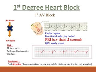 SA Node
AV Node
ECG :
PR interval is 
Prolonged but remains 
constant
Treatment :
Oral Atropine ( Pacemakers is of no use since defect is in conduction but not at nodes)
 