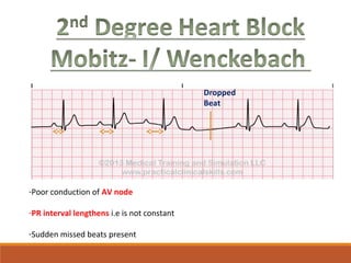 Dropped
Beat
-Poor conduction of AV node
-PR interval lengthens i.e is not constant
-Sudden missed beats present
 