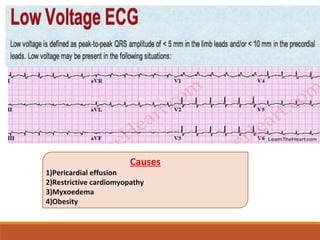 Causes
1)Pericardial effusion
2)Restrictive cardiomyopathy
3)Myxoedema
4)Obesity
 