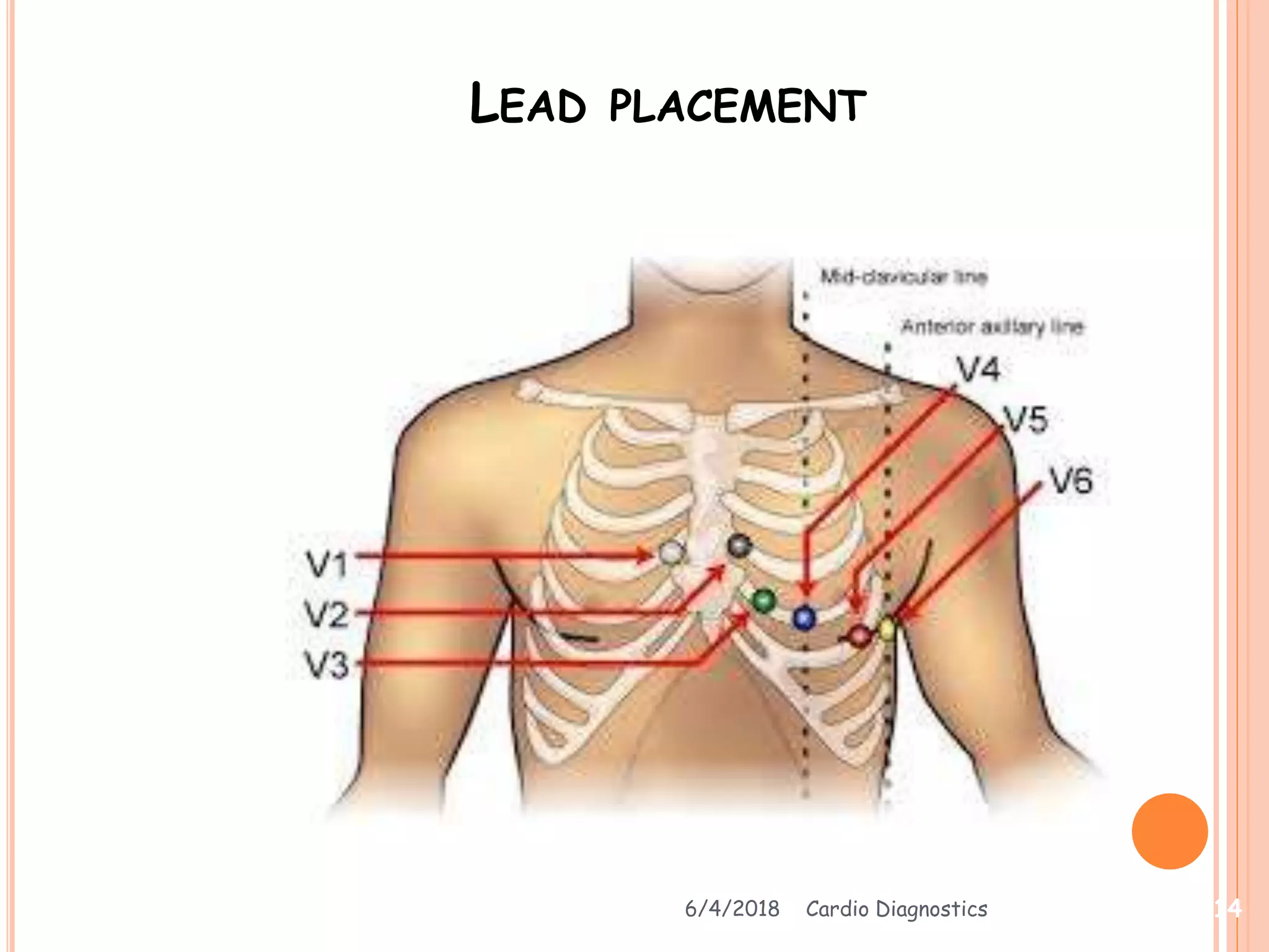 LEAD PLACEMENT
6/4/2018 Cardio Diagnostics 14
 