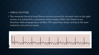 Ecg | PPTX