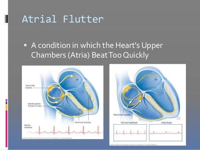 episodic atrial flutter icd 10 episodic atrial flutter icd 10