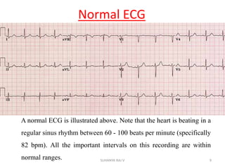 Normal ECG
A normal ECG is illustrated above. Note that the heart is beating in a
regular sinus rhythm between 60 - 100 beats per minute (specifically
82 bpm). All the important intervals on this recording are within
normal ranges. 9SUHANYA RAJ V
 