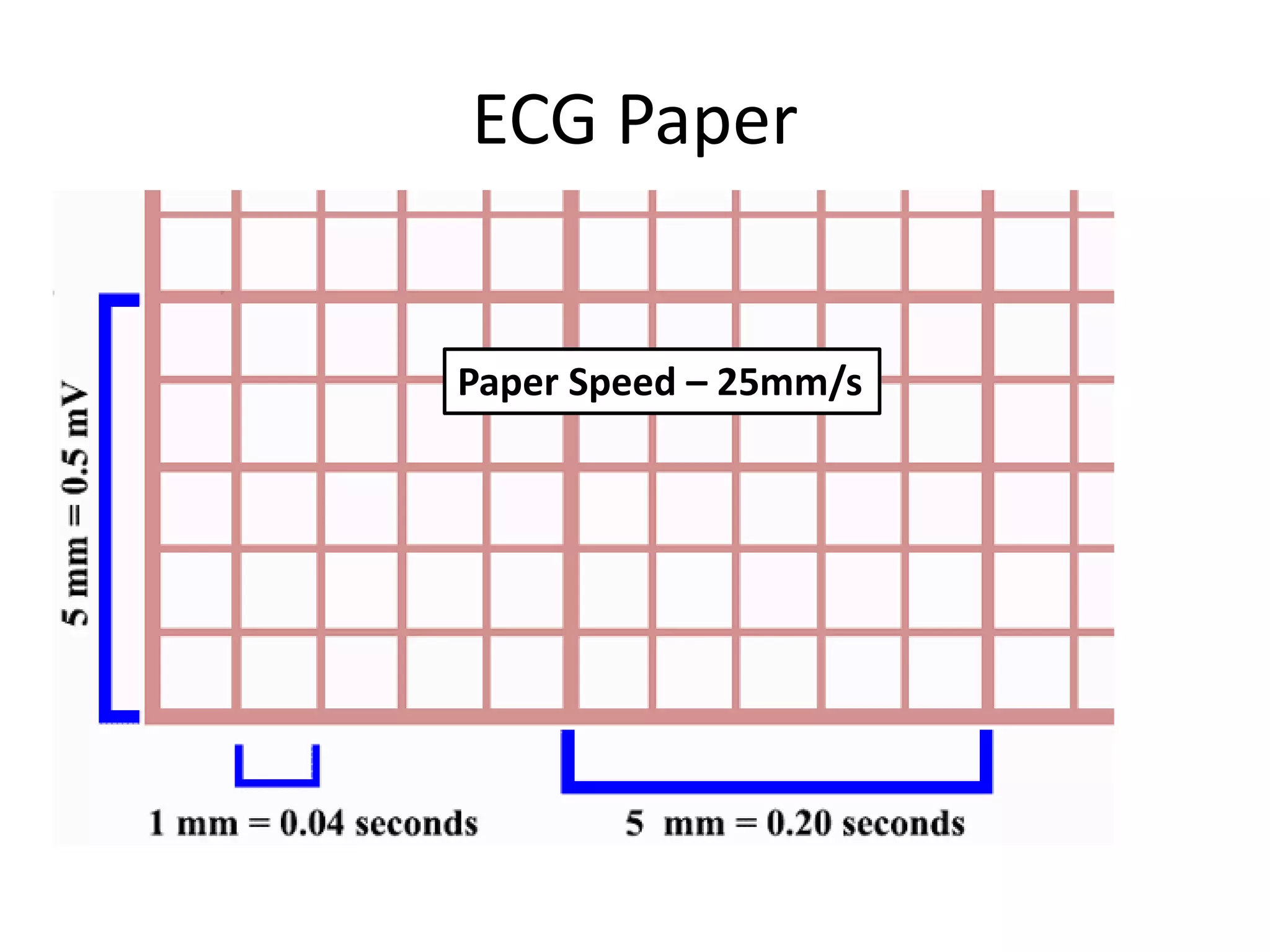 ECG Paper
Paper Speed – 25mm/s
 