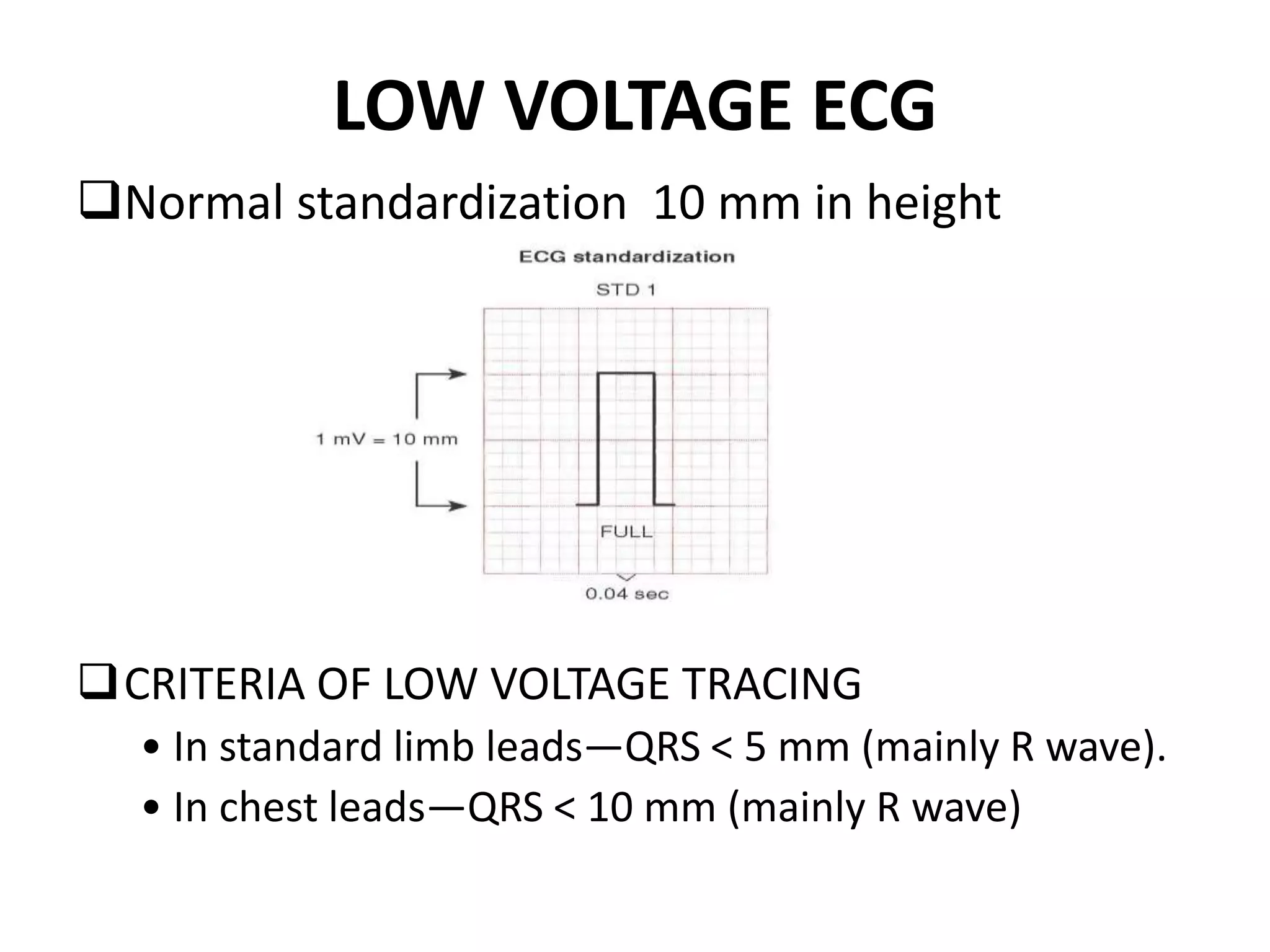 LOW VOLTAGE ECG
Normal standardization 10 mm in height
CRITERIA OF LOW VOLTAGE TRACING
• In standard limb leads—QRS < 5 mm (mainly R wave).
• In chest leads—QRS < 10 mm (mainly R wave)
 
