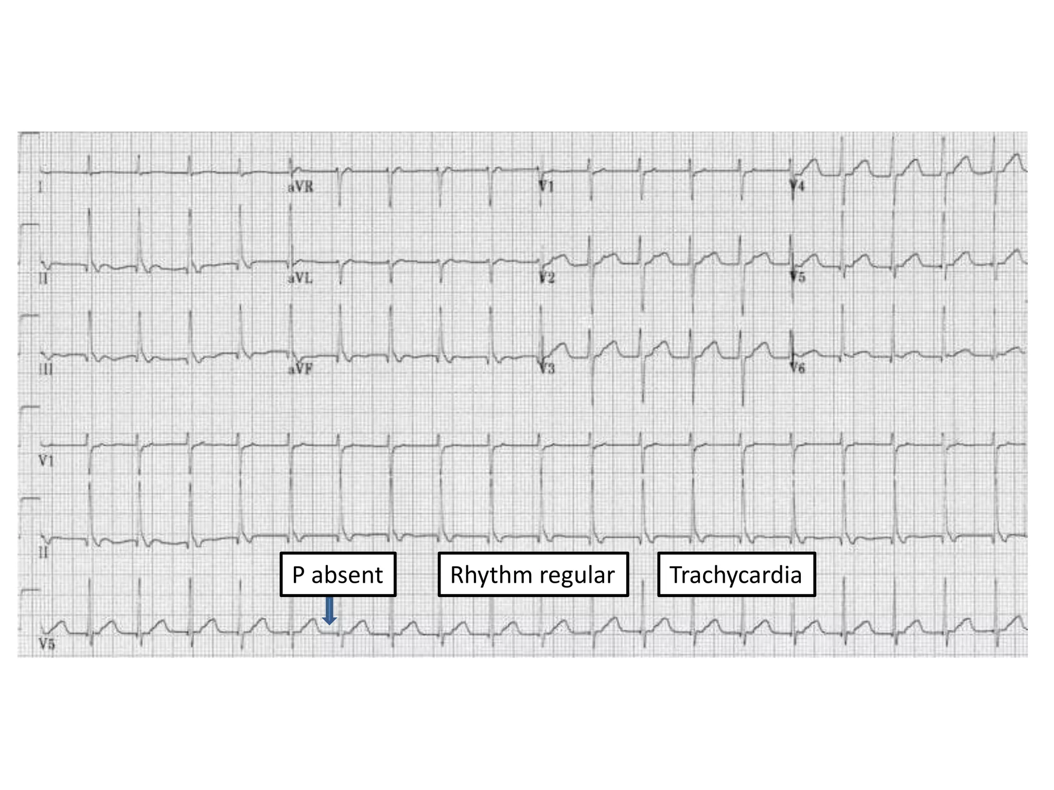 P absent Rhythm regular Trachycardia
 
