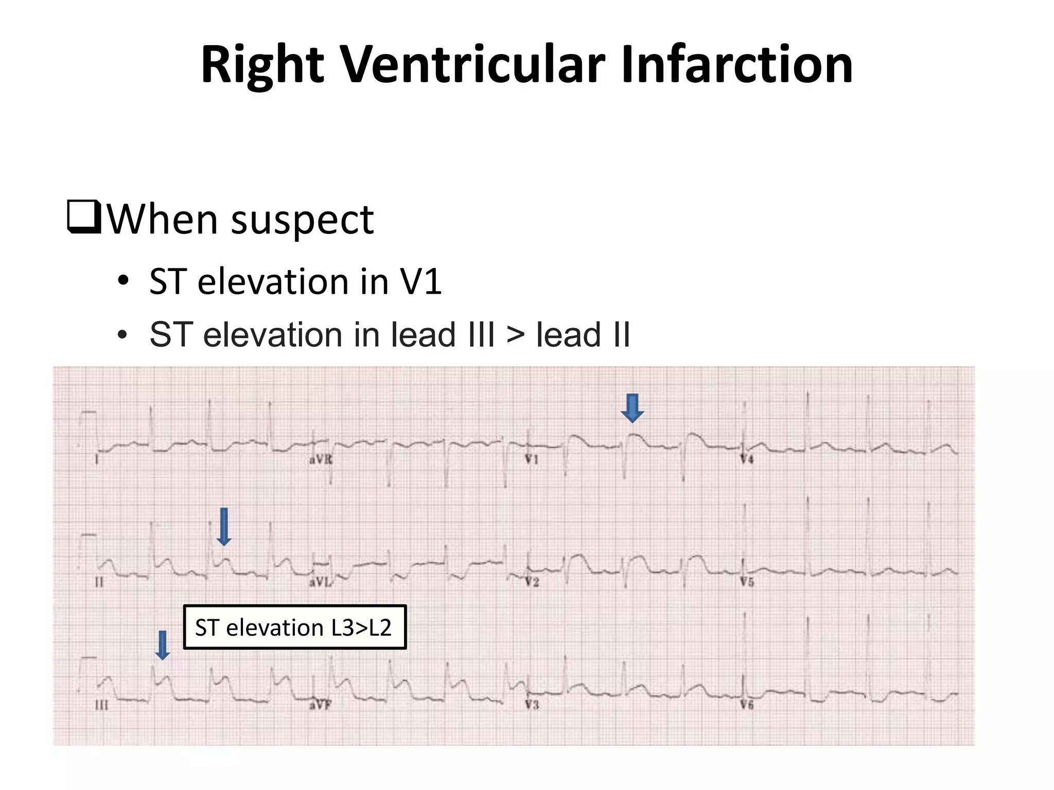 Right Ventricular Infarction
When suspect
• ST elevation in V1
• ST elevation in lead III > lead II
ST elevation L3>L2
 